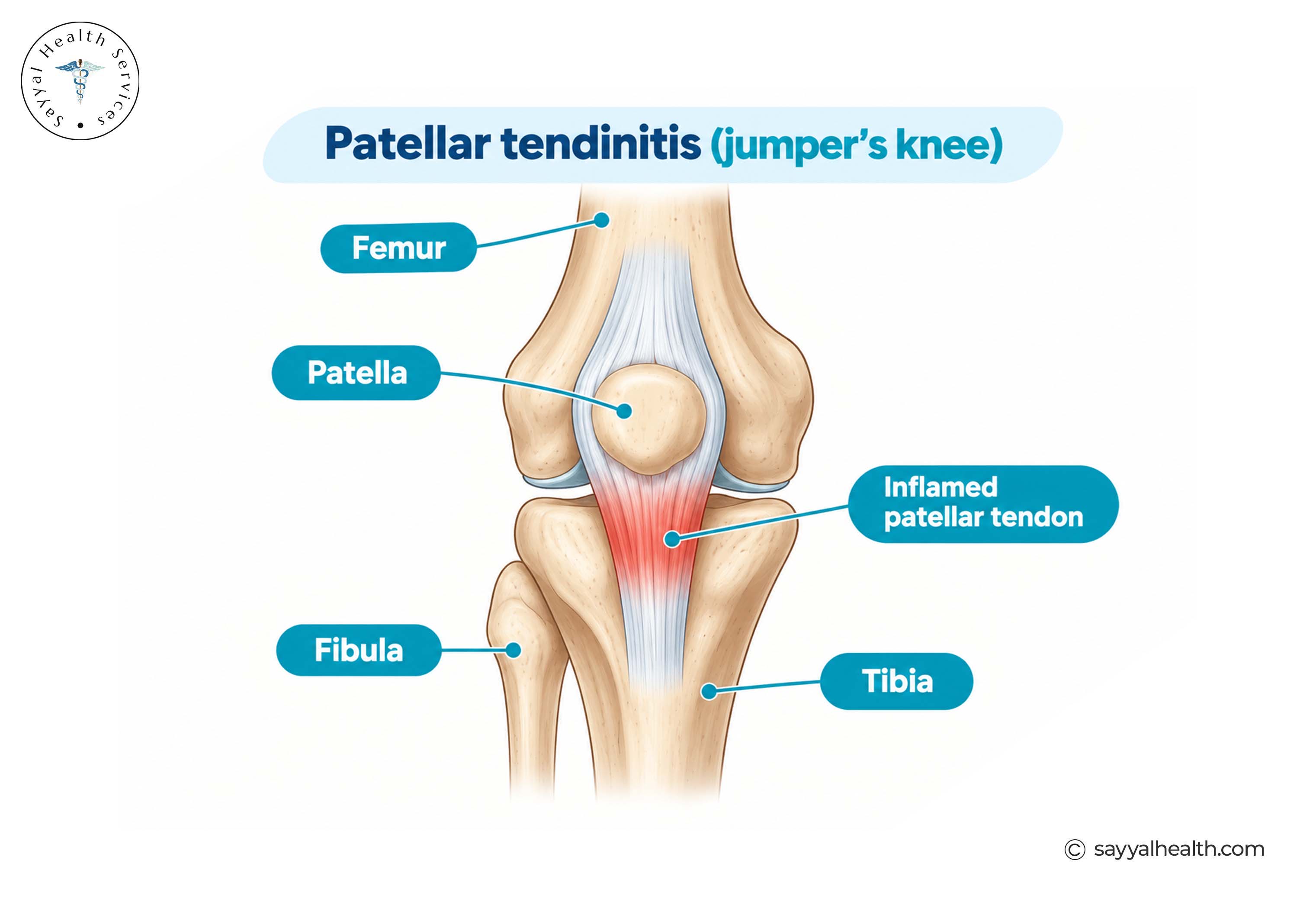 prp for patellar tendinopathy